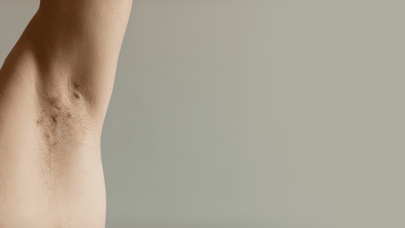 ¿Qué es la foliculitis?