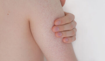 ¿Qué es la queratosis pilar?